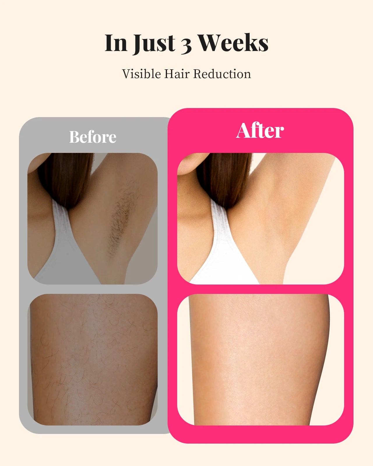 990000 Flashes Laser Hair Removal IPL for Women and Men Body Bikini Face